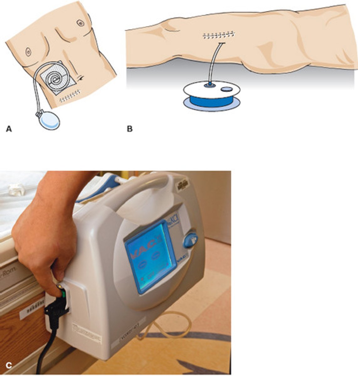 <p>Continuous suction vs dynamic pressure control (intermittent)</p><p>Suction pressure</p><p>Intensity (ramp up)</p><p>Frequency of dressing changes</p>