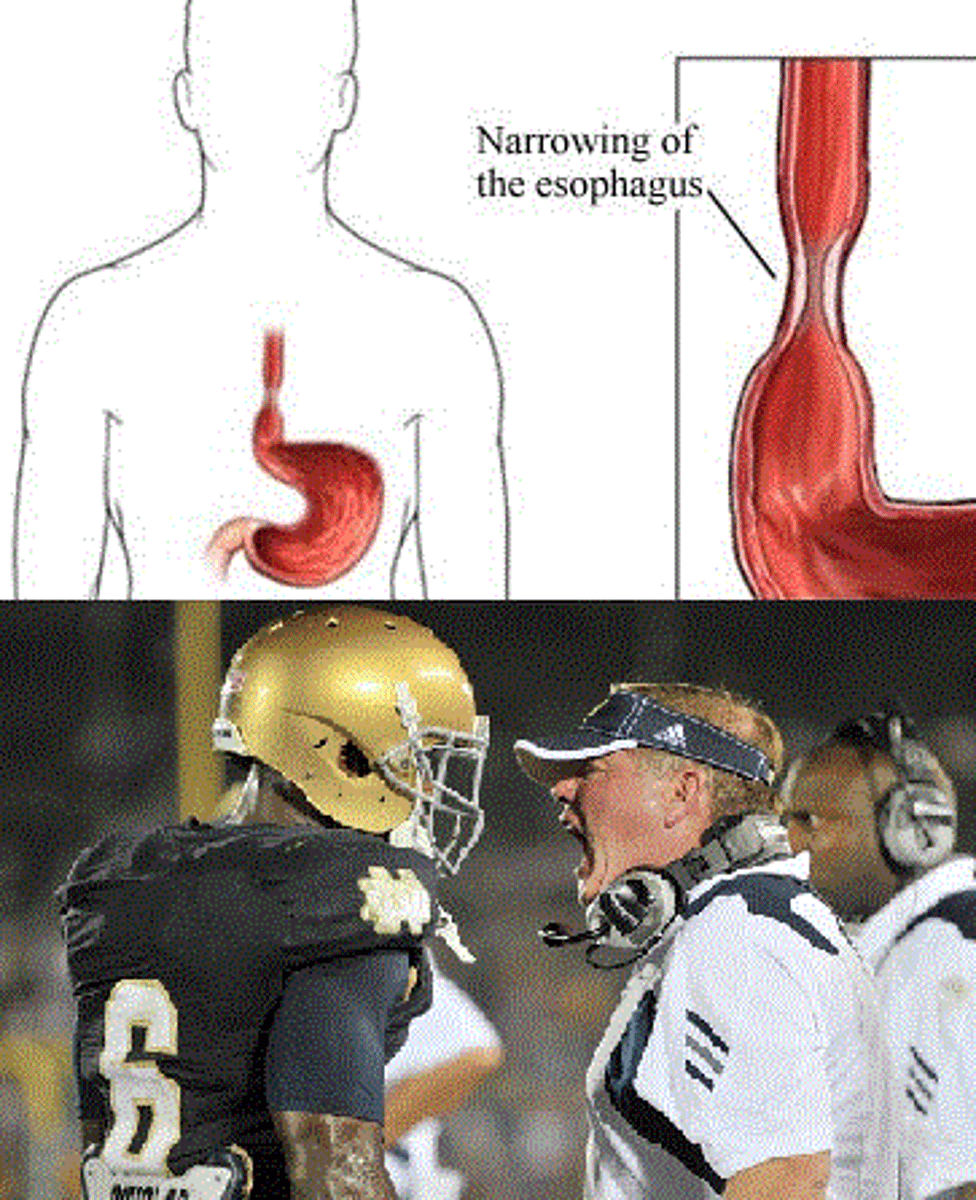 <p>an abnormal narrowing of a tubular body passage from the formation of scar tissue</p>
