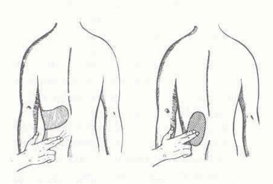 <p>Se coloca al paciente de pie o sentado de espaldas al examinador.</p><p>El médico se coloca a la izquierda del paciente, deprime la región lumbar izquierda, utilizando el pulpejo de los dedos, índice y medio de la mano derecha, dentro del área del ángulo, formado por la Intersección de la 12 costilla y la masa muscular lumbar.</p><p>Este signo es positivo, cuándo es imposible deprimir esta región, la cual normalmente se puede deprimir.</p><p>Se presenta cuando hay un aumento del volumen del riñón, como sucede en casos de hidronefrosis, quistes o tumores.</p>