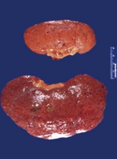 A 70-year-old woman has had a blood pressure of 160/105 mm Hg for many years. Abdominal ultrasound shows the decreased size of one kidney. What gross morphologic description applies to the abnormal kidney? What is the likely cause of this finding? How could this affect the patient's renal function? What cellular organelle plays a major role in this process? What cellular protein processing pathway is involved?  