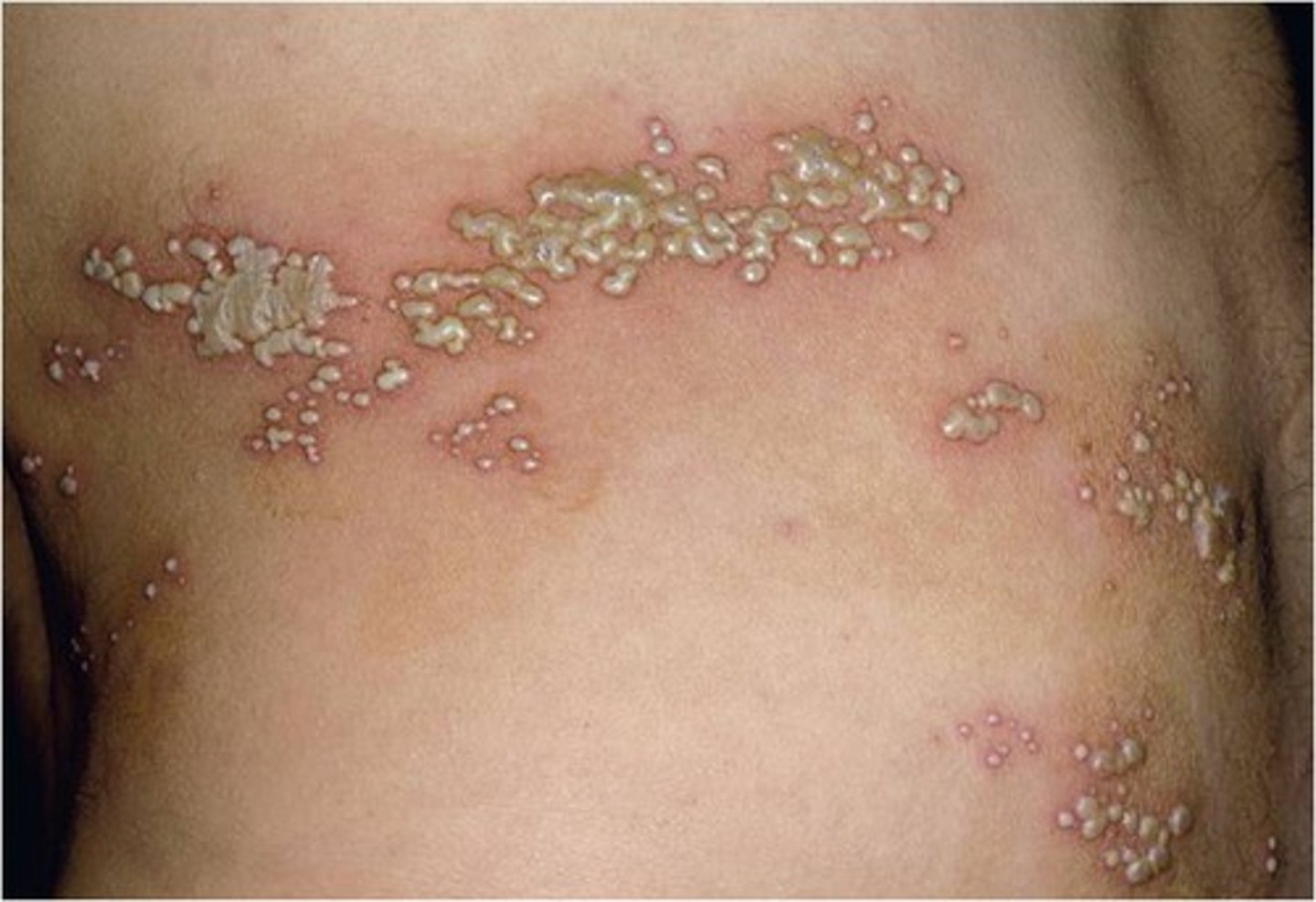 <p>← Herpes Zoster Virus</p><p>- Painful, vesicular rash</p>
