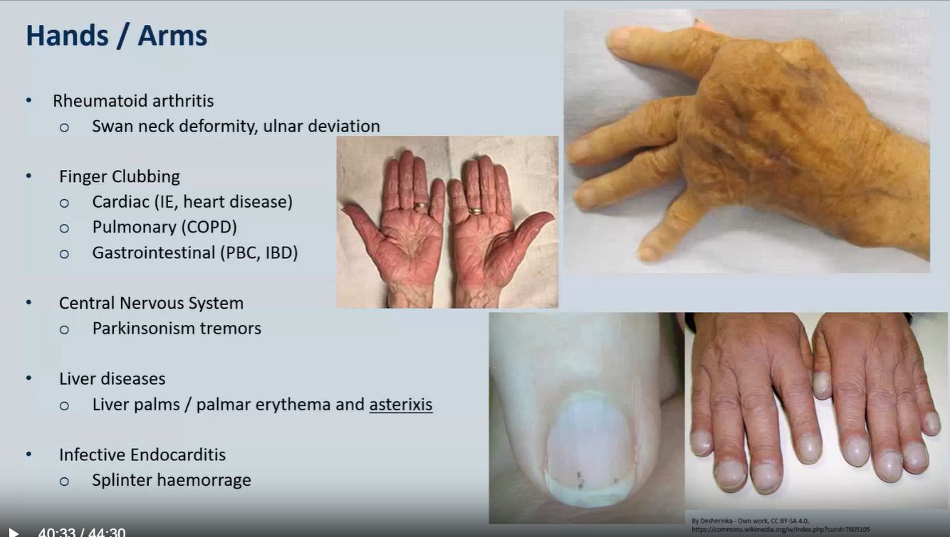 <ol><li><p>Rheumatoid arthritis</p><ul><li><p><em>Swan neck deformity, ulnar deviation</em></p></li></ul></li><li><p>Finger Clubbing</p><ul><li><p>Cardiac (IE, heart disease)</p></li><li><p>Pulmonary (COPD)</p></li><li><p>Gastrointestinal (PBC, IBD)</p></li></ul></li><li><p> Central Nervous System</p><ul><li><p>Parkinsonism tremors</p></li></ul></li><li><p>Liver diseases</p><ul><li><p>Liver palms / palmar erythema and asterixis</p></li></ul></li><li><p>Infective Endocarditis</p><ul><li><p>Splinter haemorrage</p></li></ul></li></ol><p></p>