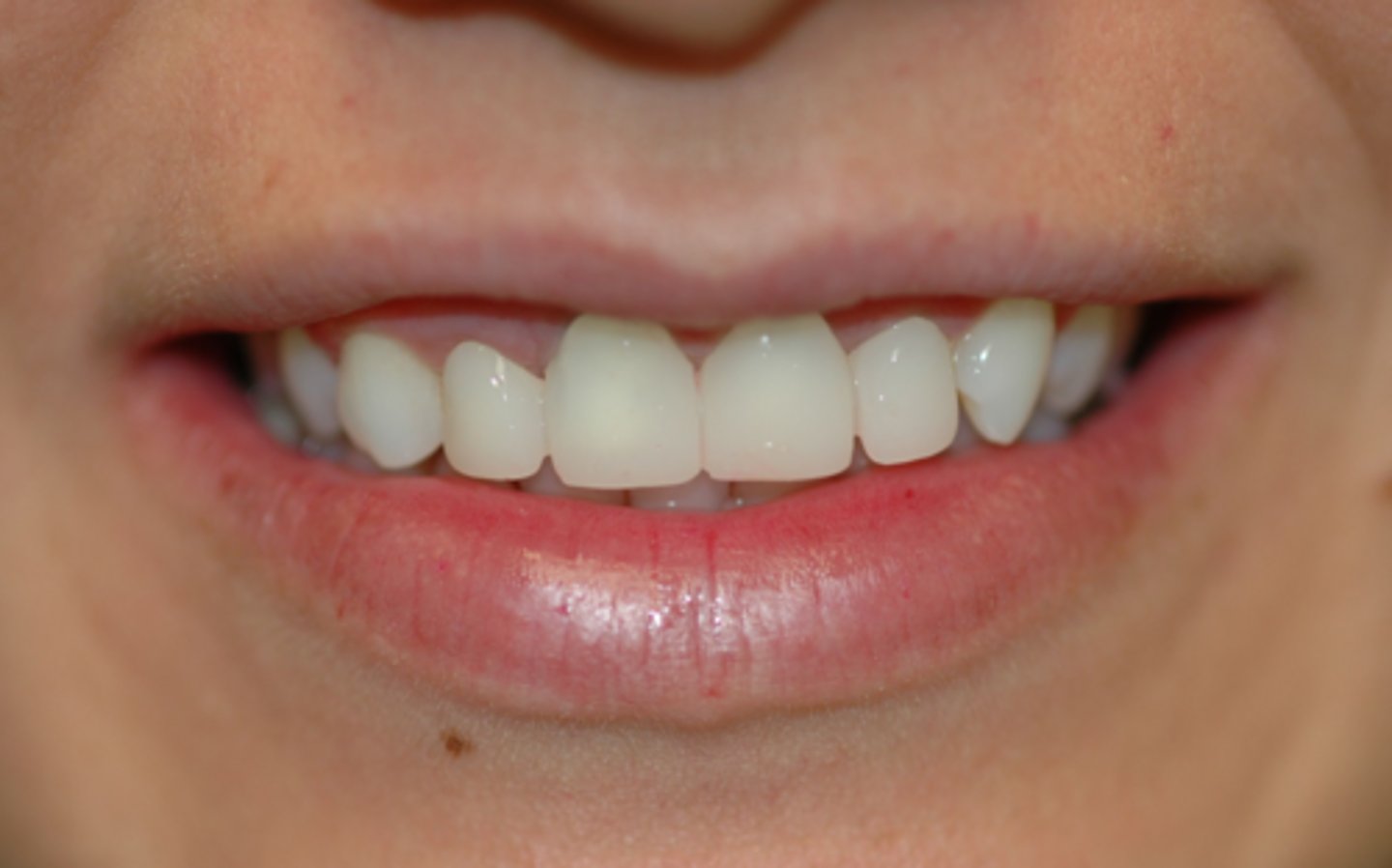 <p>What is wrong with the crown on #8?</p>