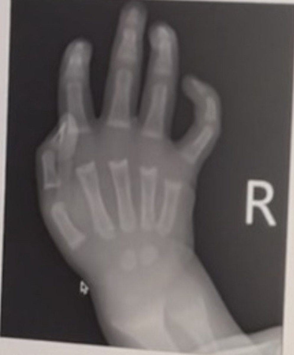<p>18 month old female with joint pain and irritability.</p><p>Most likely diagnosis:</p><p>McCune albright</p><p>Scurvy</p><p>Rickets</p><p>Neurofibromatosis</p>