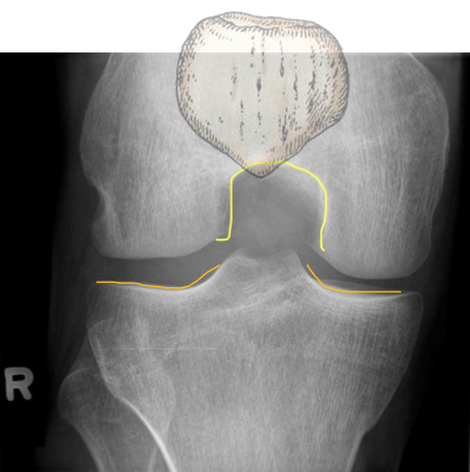 <ul><li><p>intercondylar notch open with no patella SI</p></li><li><p>tib plateau SI prox/dist</p></li></ul><p></p>