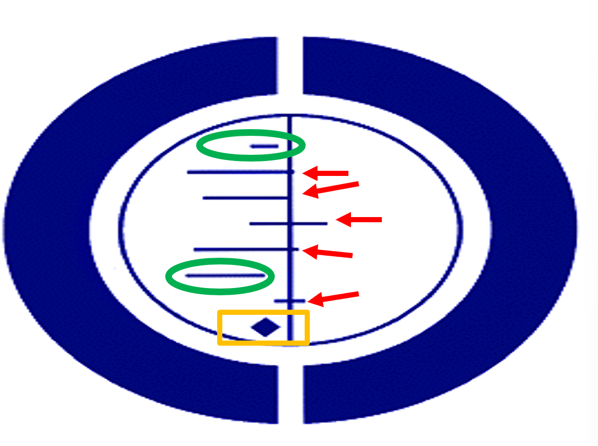 <p><strong>The Cochrane Collaboration: do meta-analysis on topics related to medicine</strong></p><p></p><ul><li><p>Got symbol from study on premature babies suffering from lung issues. Thought a treatment might be helpful.</p></li><li><p>Two studies suggested it was effective, the effect was different from 0 (green)</p></li><li><p>5 studies didn’t find any differences (red)</p></li><li><p>A meta-analysis combined results from all 7, it didn’t touch the 0 line suggesting the drug was effective, many babies saved (yellow)</p></li></ul><p></p>