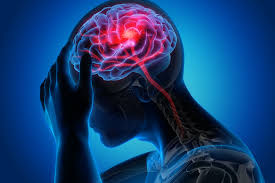 <p><strong>Which of the following clients' signs and symptoms would allow a clinician to be most</strong></p><p><strong>justified in ruling out stroke as a cause? An adult</strong></p><p>A) has had a gradual onset of weakness, headache, and visual disturbances over the last 2 days.</p><p>B) has experienced a sudden loss of balance and slurred speech.</p><p>C) has vomited and complained of a severe headache.</p><p>D) states that his left arm and leg are numb, and gait is consequently unsteady.</p>