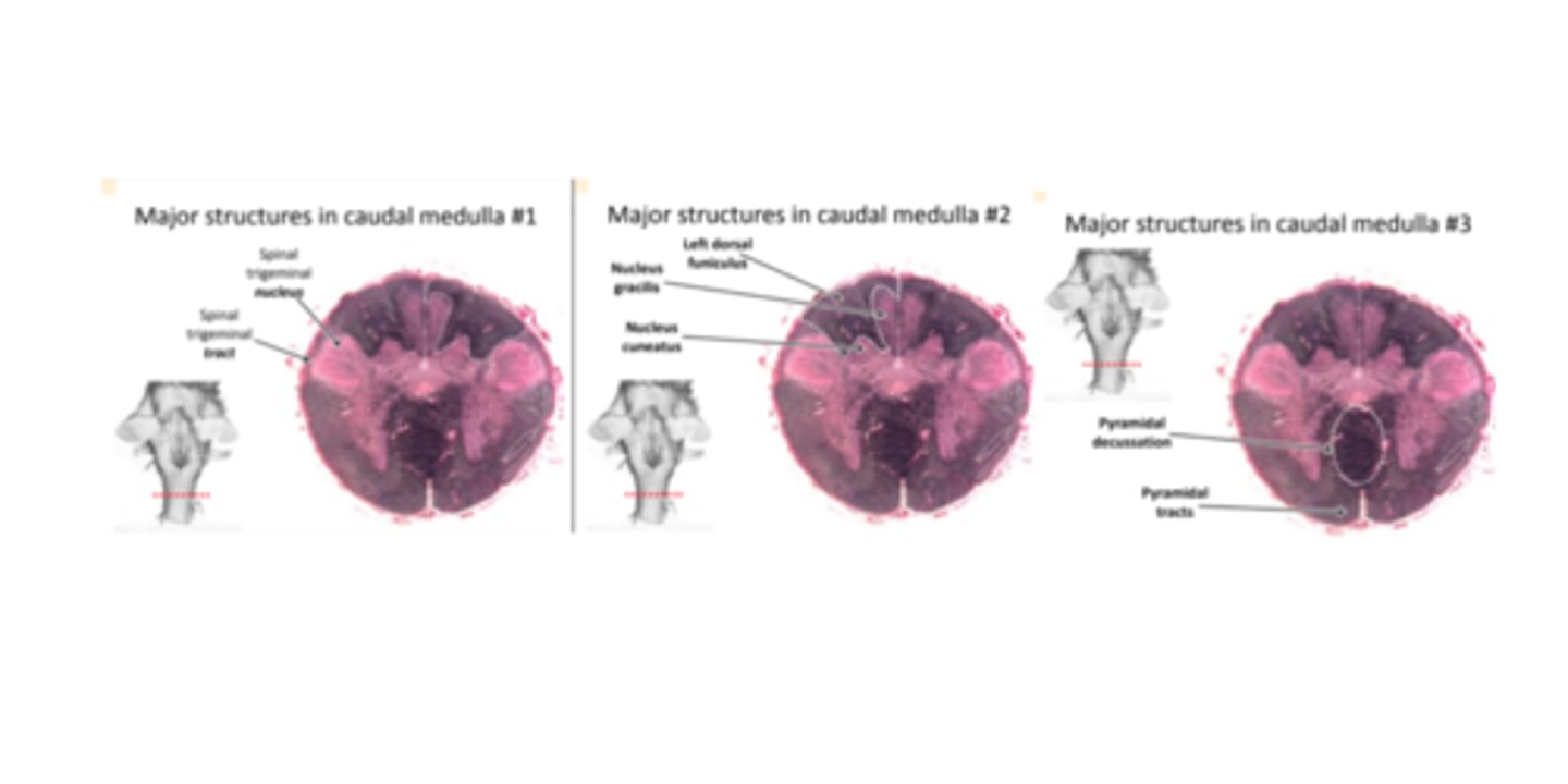<p>- Spinal Trigeminal Tract and Nucleus<br>- Nucleus Cuneatus<br>- Nucleus Gracilis<br>- Left Dorsal funinculus<br>- Pyramidal decussation<br>- Pyramidal Tracts</p>
