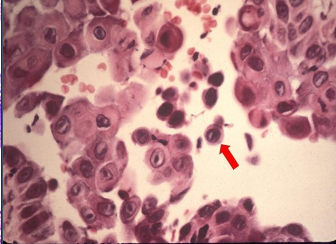 <p>Loss of attachment between the epithelial cells results in detached cells that appear rounded, present in the area of separation</p>