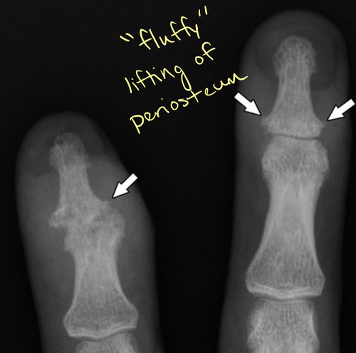 <p>New bone formation</p><p>Occurs at the periarticular area owing to enthesitis</p><p>The surface of bone erosion and proliferation in psoriatic arthritis may appear "fluffy"</p>