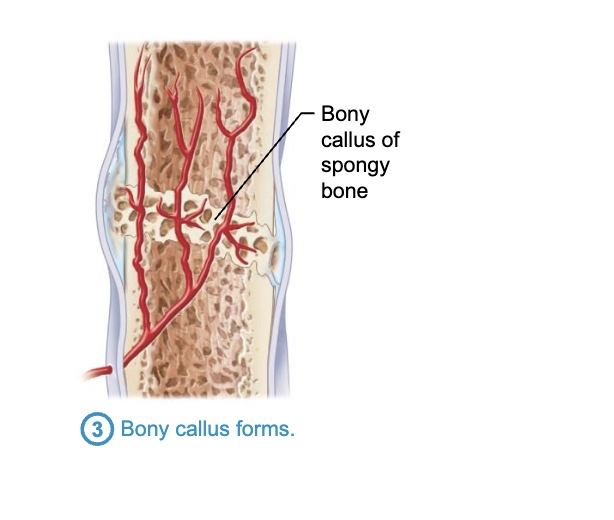 <p>– Within one week, new trabeculae appear in fibrocartilaginous callus</p><p>– Callus is converted to bony (hard) callus of spongy bone</p><p>– Bony callus formation continues for about 2 months until firm union forms</p><p></p>