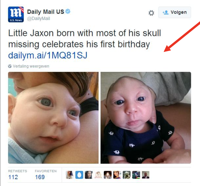 \
* open skull
* closing of neural tube failed
* usually miscarriage or death shortly after birth