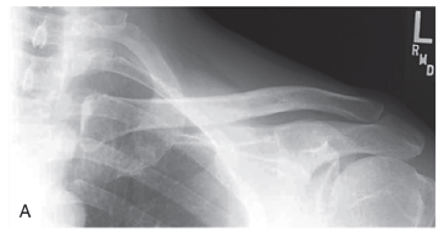 <p>- CR perpendicular</p><p>to midclavicle</p><p>- Entire clavicle demonstrated</p><p>- Four-sided collimation</p><p>- Optimal exposure factors</p><p>- AP axial</p>