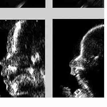 <p>Mild macroglossia can be found in trisomy 21 (Down syndrome), whereas severe macroglossia is typical of Beckwith–Wiedemann syndrome</p><p></p><p></p><p>Micrognathia is associated with trisomy 18 and with a considerable number of nonchromosomal syndromes (fetal akinesia deformation sequence [FADS], skeletal dysplasia, etc.).</p>