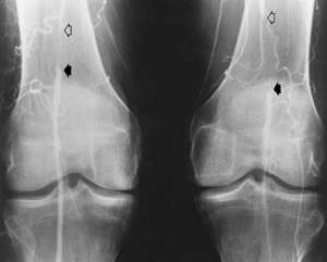 <p>this is atherosclerosis, waht is the treatment </p>