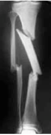 <p>Would this fracture be described as comminuted or segmental?</p>