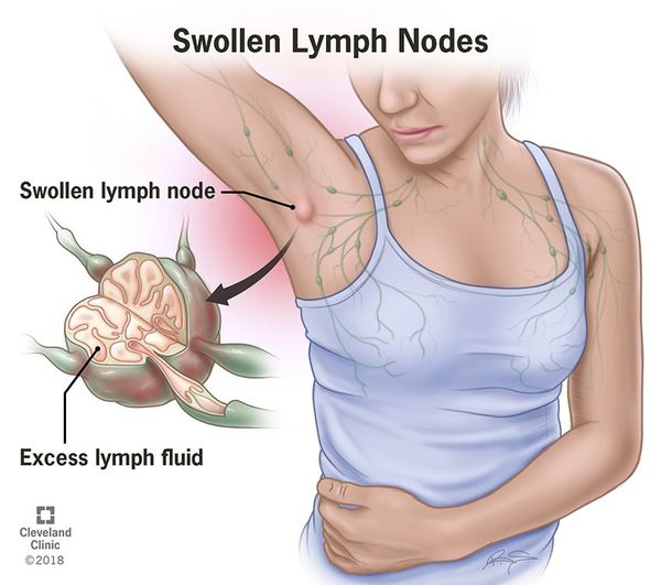 <p>Filters lymph from the <strong><u>chest, upper limbs, abdomen &amp; back.</u></strong></p><p>Noticeable ailments:</p><ul><li><p>Infection in drained areas</p></li><li><p>Swelling can indicate breast cancer</p></li></ul><p></p>