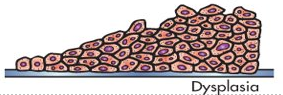 <p>abnormal cellular growth; atypical hyperplasia</p>