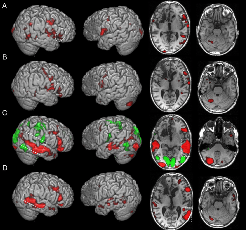 <p>investigated:</p><ul><li><p>studied fMRI - type of brain scan that shows which part of the brain are activating during certain tasks through using strong magnets to take detailed photos of the brain - to determine if emotional responses were more present in certain areas of the brain</p></li></ul><p>findings:</p><ul><li><p>the <strong>prefrontal cortex is involved in cognitive reappraisal</strong>, as is the <strong>amygdala</strong>, which has been implicated in emotional responding</p></li><li><p>they found that the a<strong>mygdala’s involvement changes </strong>depending on what the <strong>reappraisal </strong>is trying to <strong>achieve</strong></p></li></ul><p></p>