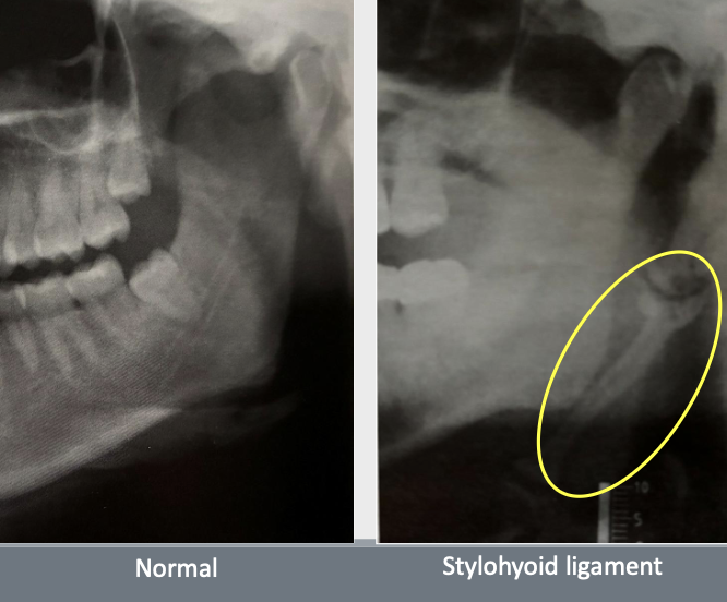 <p><span style="color: #000000">Elongation of styloid process or mineralization of the stylohyoid ligament</span></p><ul><li><p><span style="color: #000000">Sometimes pain during opening mouth, swallowing, turning head sideways</span></p></li><li><p><span style="color: #000000">Usually bilateral but can be unilateral</span></p></li><li><p><span style="color: #000000">Treatment depends on severity</span></p></li></ul><p></p>