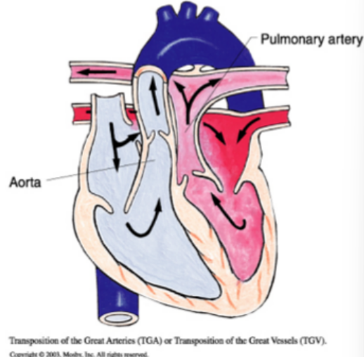 <p>pulmonary artery leaves the left ventricle and aorta leave the right ventricle,&nbsp;“egg on a string” appearance on X-Ray, incompatible with life unless ASD, VSD, and/or PDA is present, prostaglandin E given to maintain PDA, cyanotic</p>