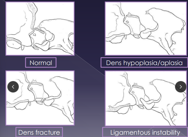 <ul><li><p><span style="color: red;"><strong>C1-C2</strong></span></p></li><li><p><span style="color: rgb(136, 136, 136);"><strong>Et: </strong></span>congenital, <strong>dens aplasia, dens hypoplasia</strong>, dorsal angulation, ligament laxity, trauma</p><ul><li><p><strong><u>cranial axis(C2) dorsal displacement in relation to C1,  cord compression</u></strong></p></li></ul></li><li><p><span style="color: rgb(136, 136, 136);"><strong>Sig:</strong></span><span style="color: red;"><strong> young, sm breeds</strong></span></p></li><li><p><span style="color: rgb(136, 136, 136);"><strong>Cs:</strong></span><strong> <u>neck pain(30-60%), progressive tetraparesis, ataxia,</u> <u>neuro defects(94%)</u></strong></p></li><li><p><span style="color: rgb(136, 136, 136);"><strong>Dt: </strong></span><strong><u>rads (C1-2 misalignment)</u></strong>, CT/MRI</p><ul><li><p><span style="color: red;"><strong><u>do NOT flex neck!!</u></strong></span></p></li></ul></li><li><p><span style="color: rgb(136, 136, 136);"><strong>Tx:</strong></span><strong> <u>6-8w rest, neck brace, NSAID, gabapentin, Sx A-A fusion (#1)</u></strong></p><ul><li><p>Moderate peri-op mortality</p></li></ul></li></ul><img src="https://knowt-user-attachments.s3.amazonaws.com/c4c4e22b-d053-459f-9e7a-5139962ac077.png" data-width="50%" data-align="center"><p></p>