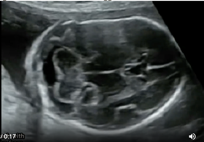 <p>a) osteogenesis imperfecta</p><p>b) arthrogryposis </p><p>c) thanatophoric dysplasia</p><p>d) ellis van creveld syndrome </p>