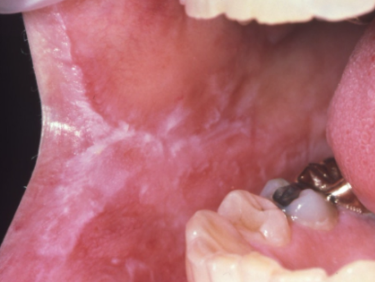 <p>best treatment for cinnamon-induced lichenoid mucositis?</p>