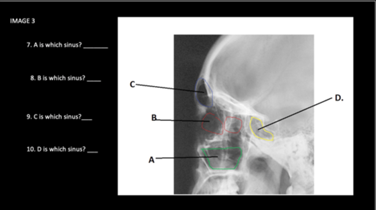 <p>C is which sinus?</p>