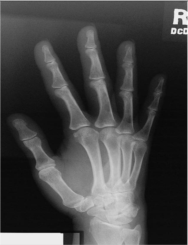 <p><span style="line-height: normal;">• </span>Entire hand and carpals demonstrated</p><p class="p1"><span style="line-height: normal;">• </span>Midshafts of metacarpals should not overlap</p><p class="p2"><span style="line-height: normal;">• </span>Heads of 3<span style="line-height: normal;">rd</span>,4<span style="line-height: normal;">th</span>,5<span style="line-height: normal;">th</span> metacarpals are slightly overlapped</p><p class="p2"><span style="line-height: normal;">• </span>Minimal overlap of heads of 2<span style="line-height: normal;">nd</span> &amp; 3<span style="line-height: normal;">rd</span></p><p class="p2"><span style="line-height: normal;">• </span>MCP and IP joints are open ( if fingers were kept parallel)</p>