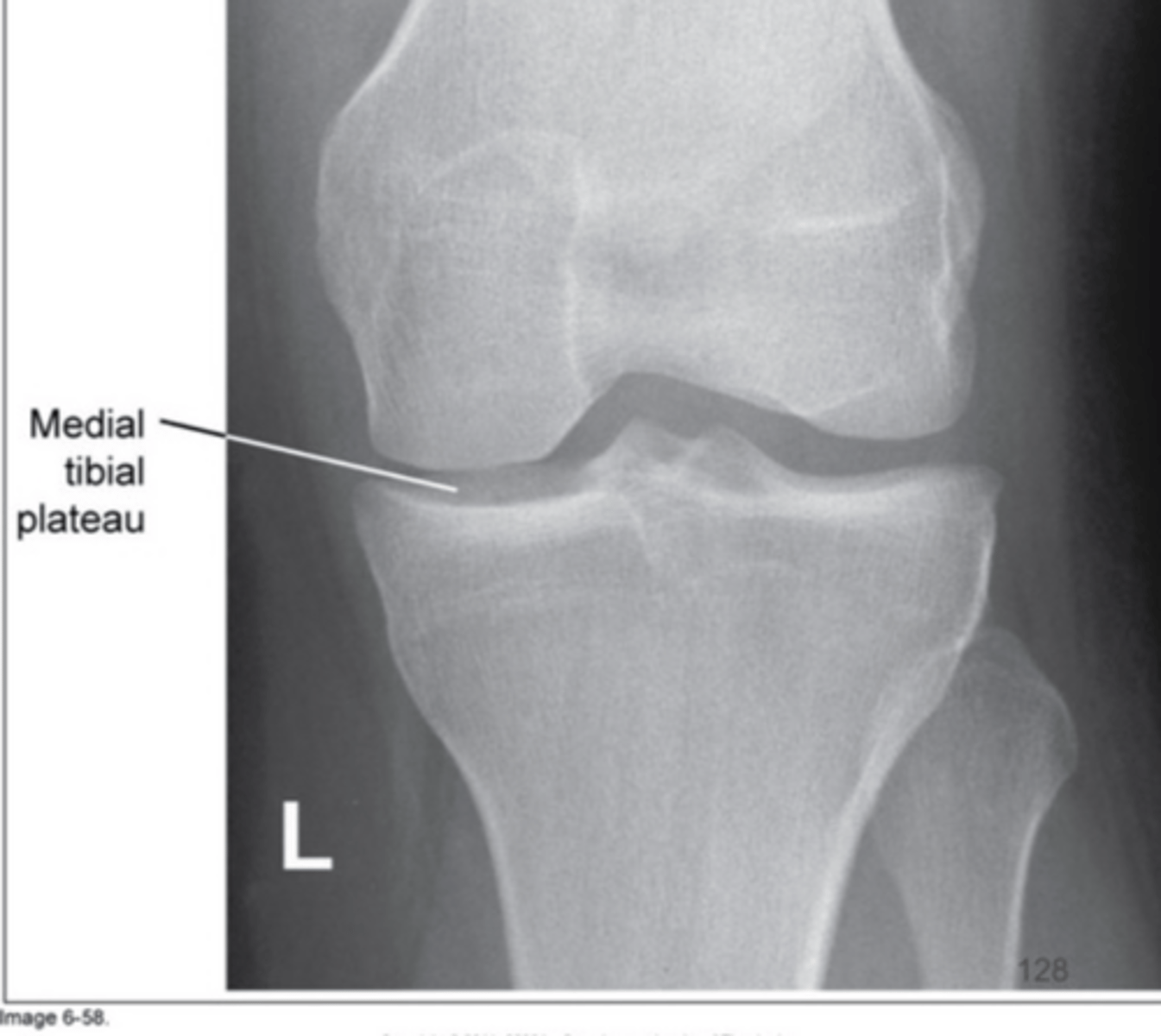 <p>Too much cephalic angle</p>