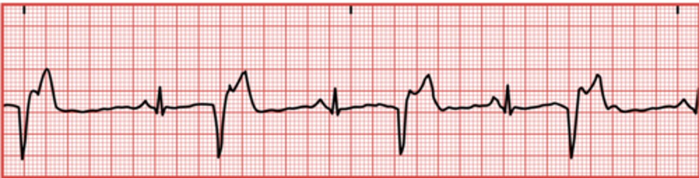 <p>When the ventricles contract before they should, resulting in a QRS complex appearing before a P wave.</p>