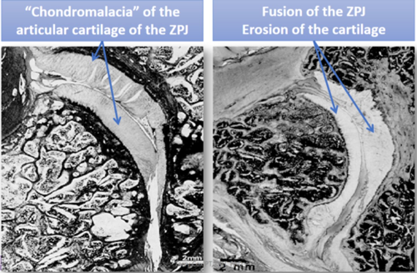 <p>- chondromalacia of articular cartilage (softening and degeneration)</p><p>- fusion of facet joints with erosion of cartilage</p>