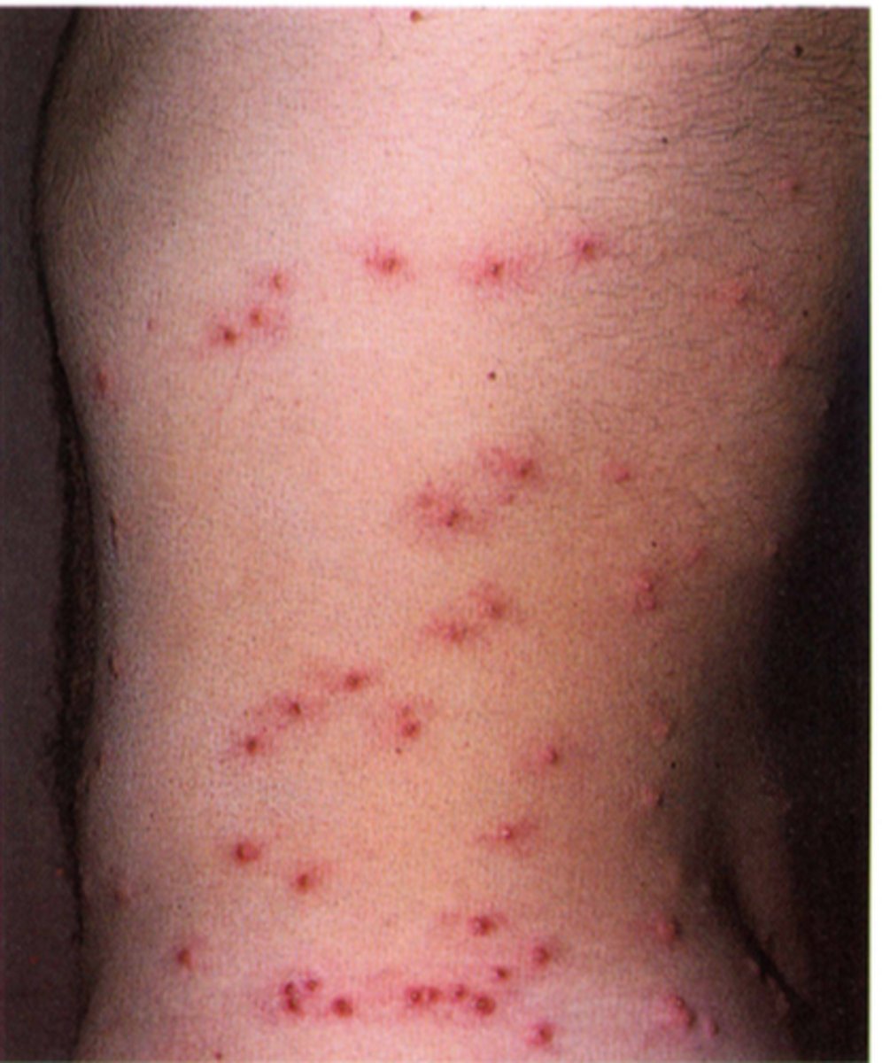 <p>Bed Bugs (Bites in 2's &amp; 3's)</p>