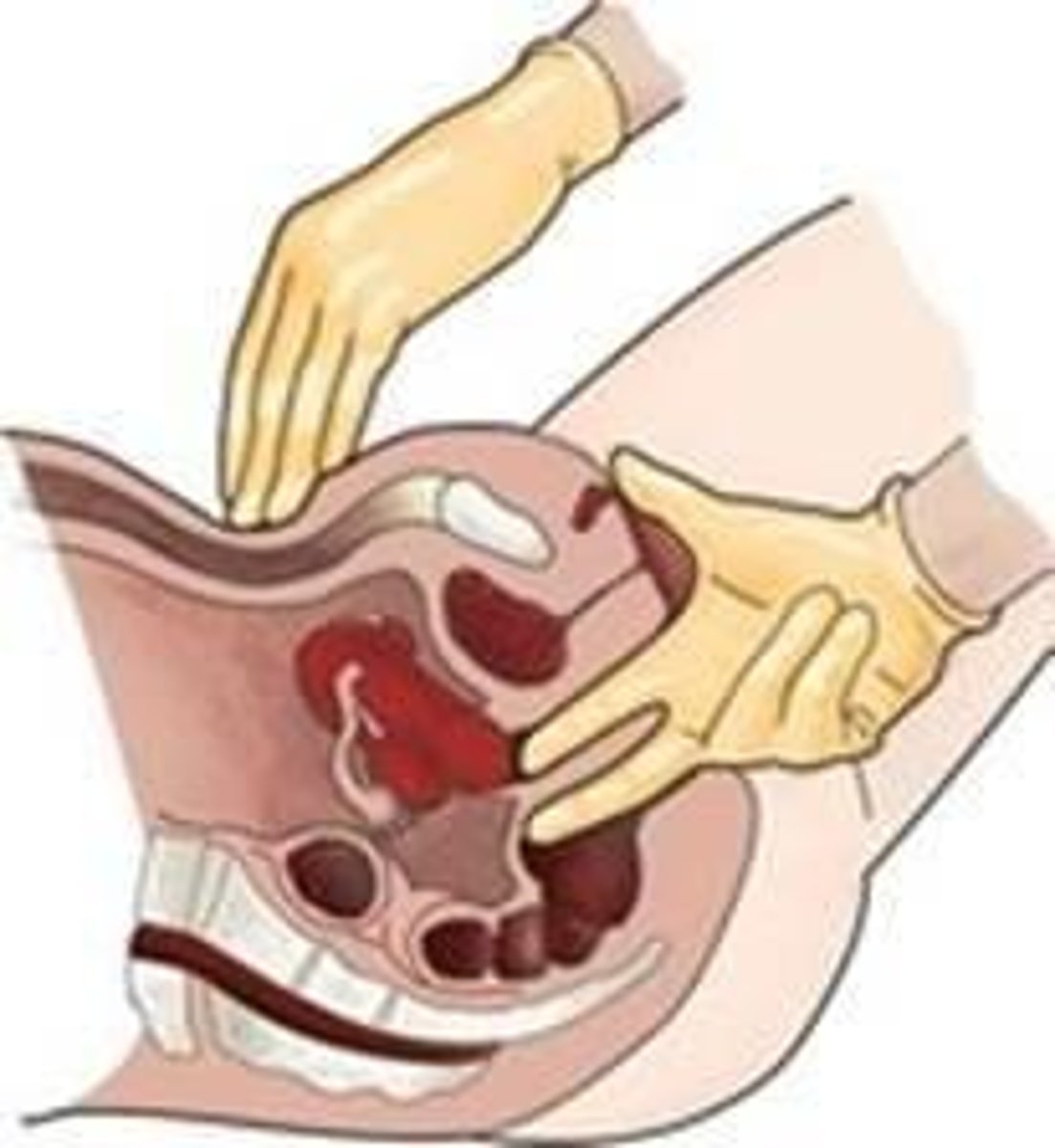 <p>Place palmar surface of outside hand on abdominal midline, halfway between umbilicus and symphysis pubis, and place intravaginal fingers in anterior fornix.</p>