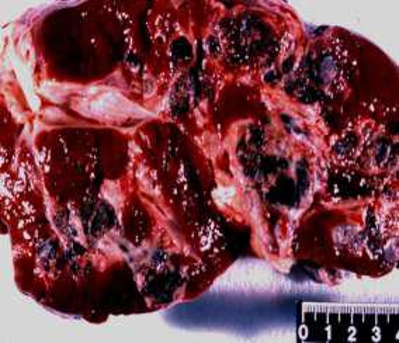 <p>It can lead to artifactually decreased values.</p>