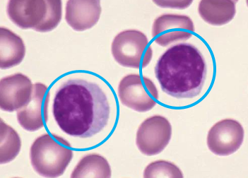 <p>TC Especial Sangre (<strong>Linfocitos</strong>)</p><ul><li><p>Poco citoplasma, núcleo grande</p></li><li><p>Leucocitos más pequeños</p></li><li><p>Junto a Neutrófilos los más numerosos</p></li><li><p>Dos tipos</p><ul><li><p>T (ataca células)</p></li><li><p>B (produce anticuerpos)</p></li></ul></li><li><p>AUMENTAN EN</p><ul><li><p>Infecciones virales y algunas leucemias</p></li></ul></li></ul><p></p>