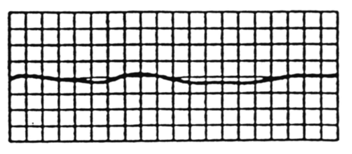 <p>Almost becomes flat line</p><p>Seen in severe dz or acute arterial occlusion</p><p>Differentiate from increased venous flow</p>