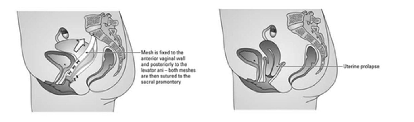 <p>surgical fixation of the uterus</p>
