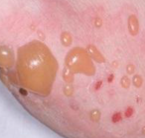 <p>large (&gt;5mm), blister-like elevation that contains fluid. </p>