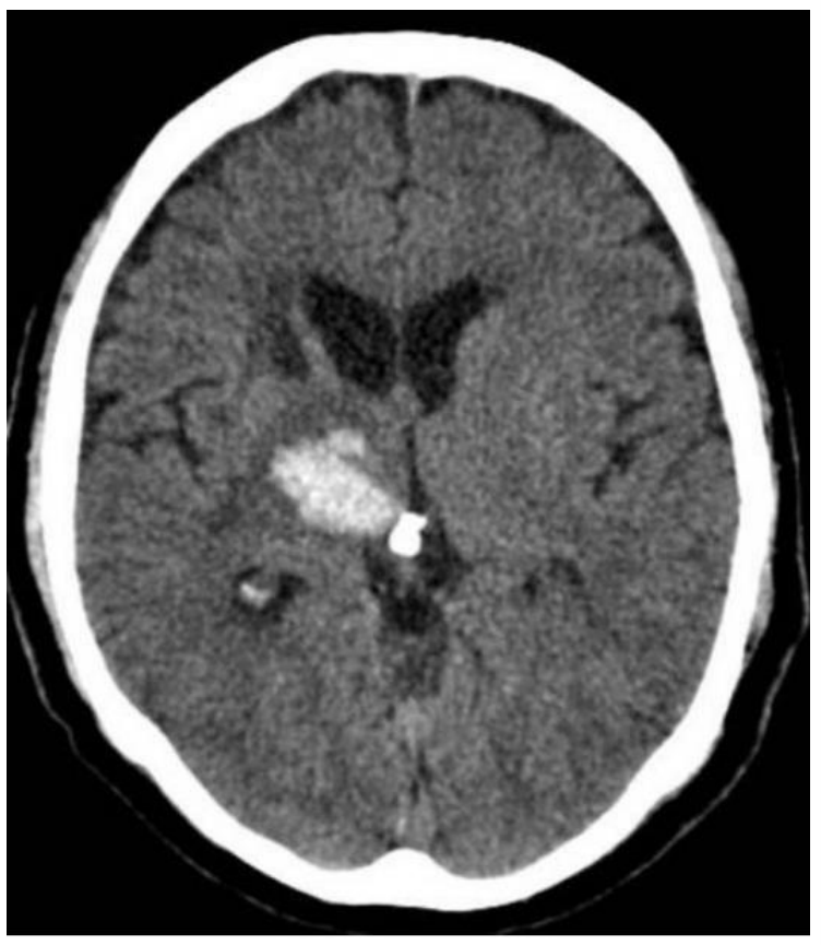 <p>A CT scan from a 72-year-old female with sudden onset sensory loss and somnolence reveals the result shown in the accompanying image. Which of the following is the most correct diagnosis?</p><p>A. Astrocytoma</p><p>B. Epidural hemorrhage</p><p>C. Intraparenchymal hemorrhage</p><p>D. Medulloblastoma</p><p>E. Meningioma</p><p>F. Multiple sclerosis</p><p>G. Subarachnoid hemorrhage</p>