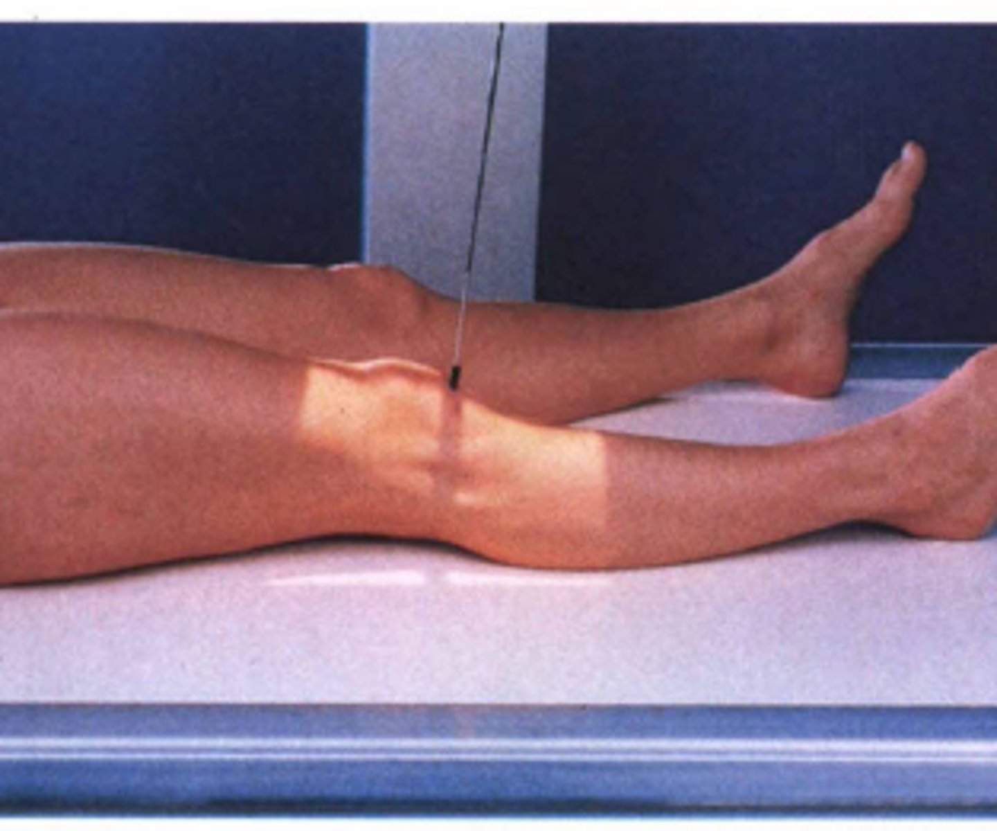 <p>1. Patient lies supine or sits upright on the x-ray couch.</p><p>2. Legs extended with the posterior aspect of the affected knee joint in contact with the IR.</p><p>3. The lower leg is rotated until the patella is centralised and the femoral condyles should be equidistant to the IR.</p><p>4. Make sure the patient's feet are facing forwards; for some patients the toes may need to be turned inwards (but not always).</p>