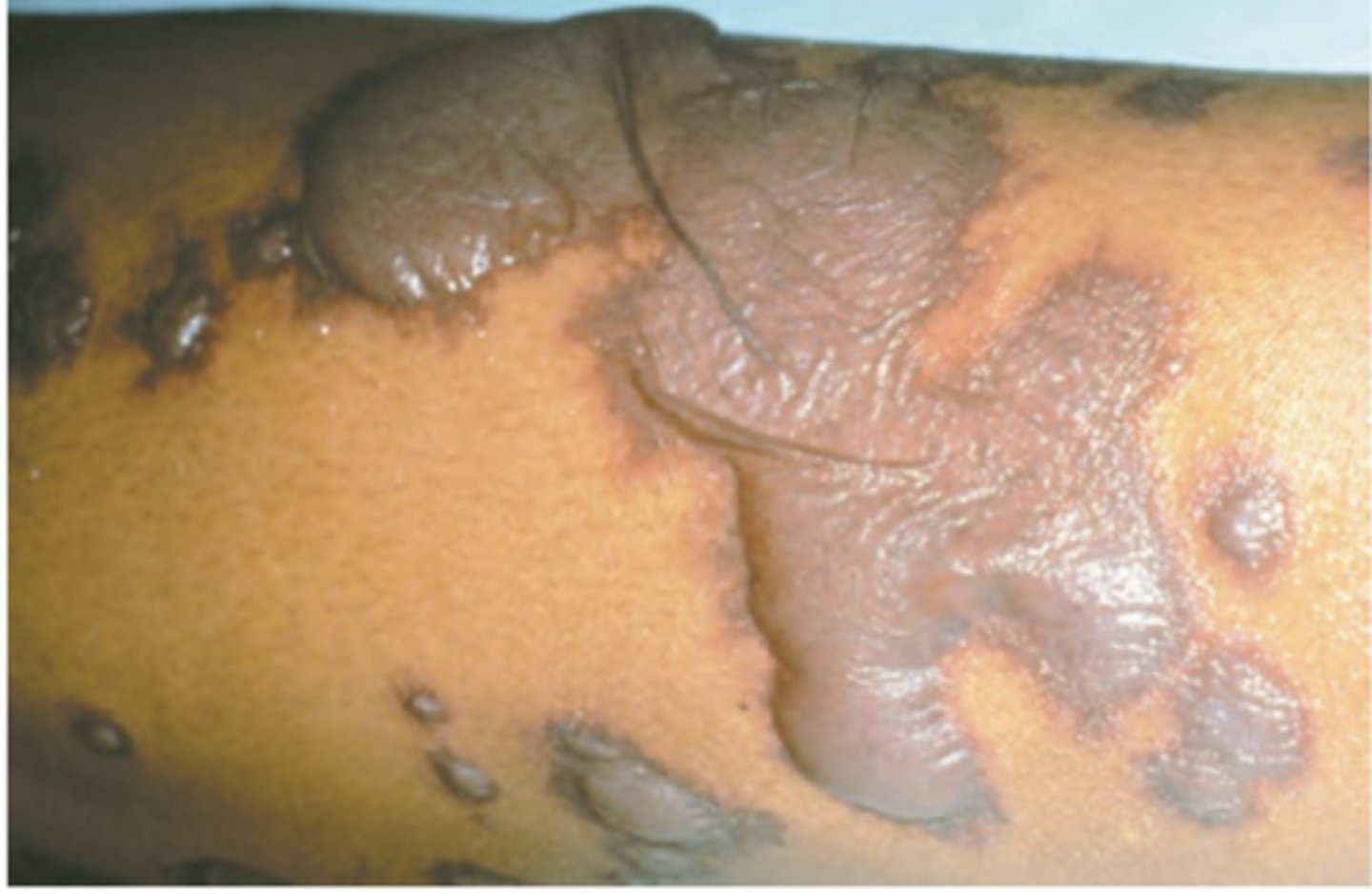 <p>Hint: Previously considered most severe form of erythema multiforme</p>