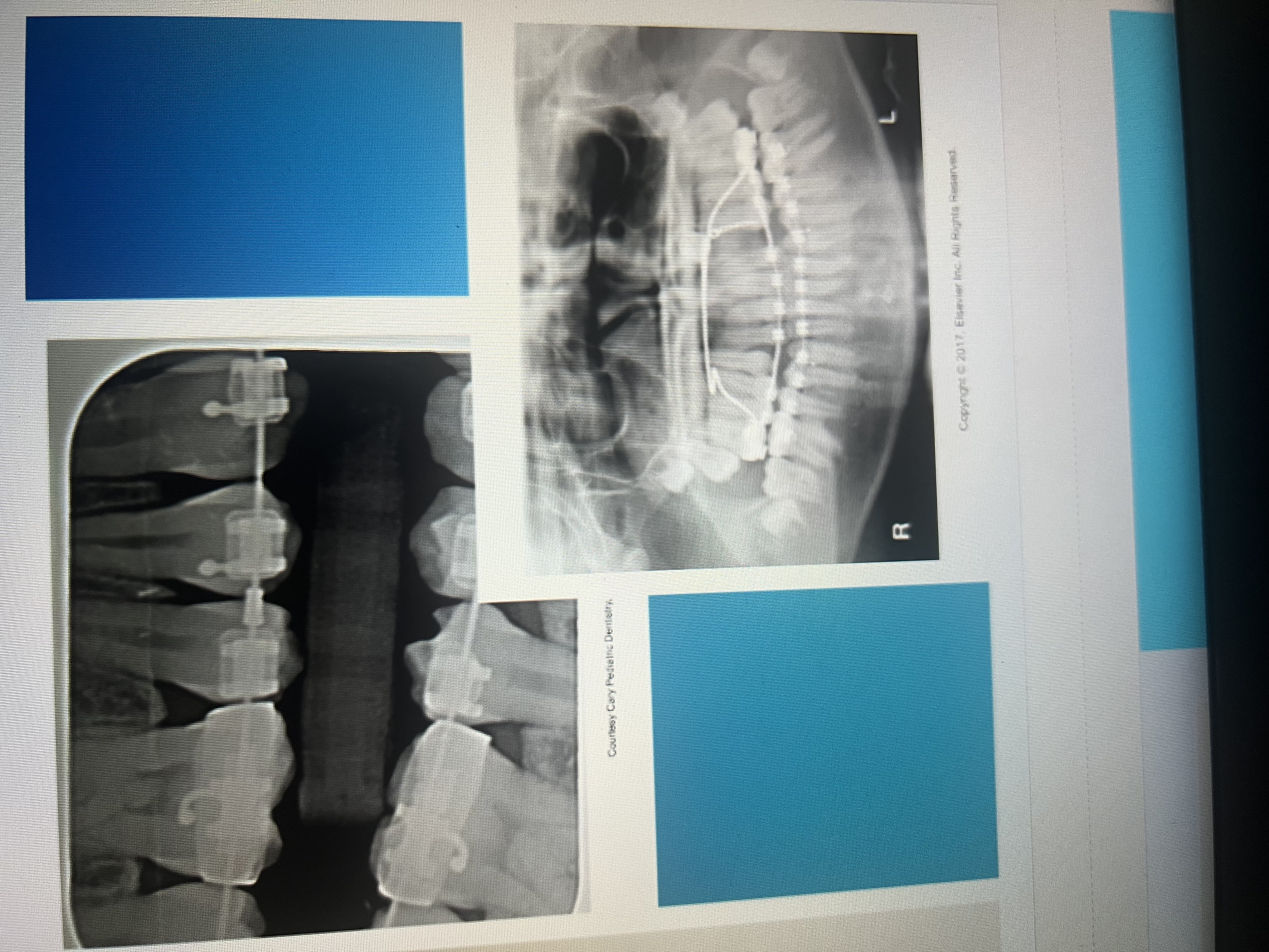 <p>White radiopaque</p>