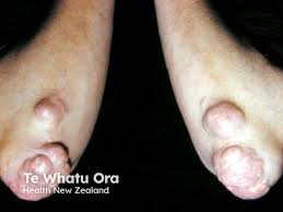 <p>plaques found over elbows and knees caused by <mark data-color="blue" style="background-color: blue; color: inherit;">high IDL</mark></p>