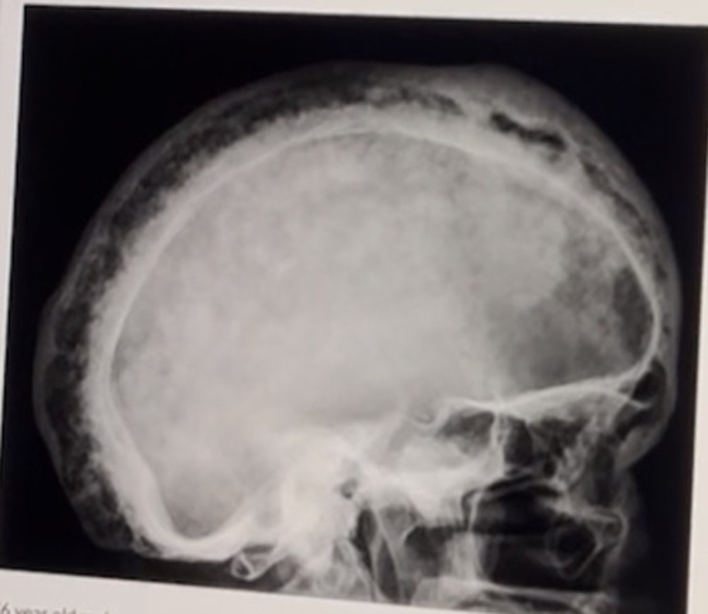 <p>Paget disease, basilar invagination</p><p>2 multiple choice options</p>