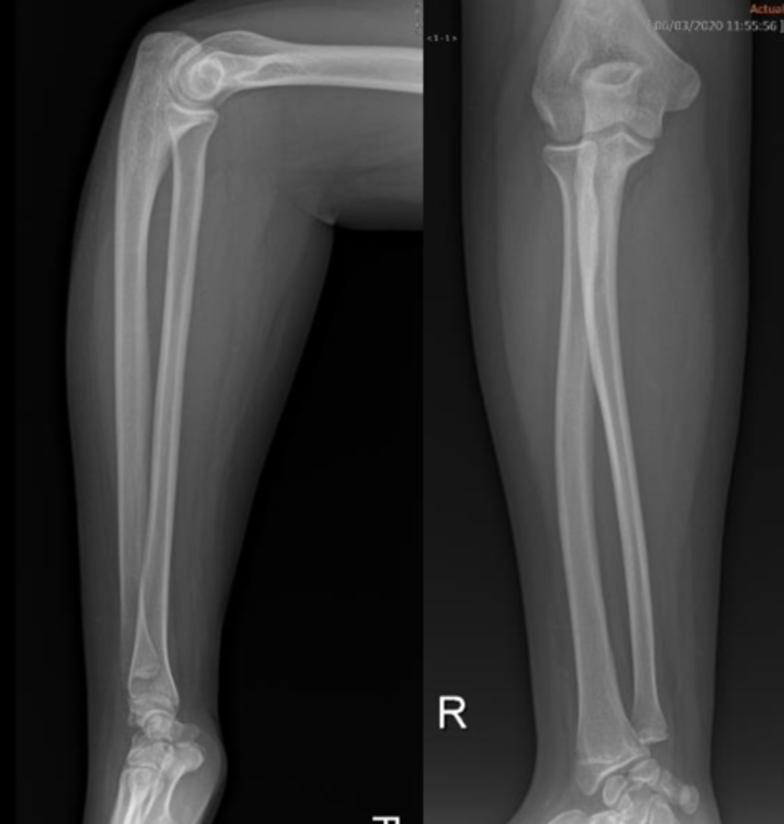 <p>The forearm is studied using AP (anteroposterior) and lateral projections.</p>