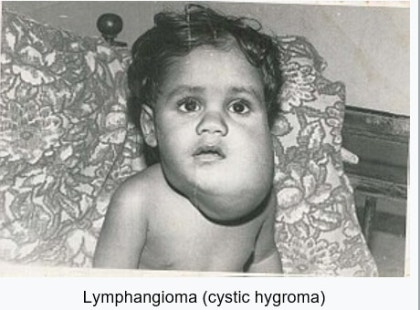 <p class="ds-markdown-paragraph">A benign malformation of the lymphatic system,<span style="color: blue;"> often present at birth, resulting from abnormally formed lymphatic vessels.</span></p><ul><li><p class="ds-markdown-paragraph"><strong>Etymology:</strong></p><ul><li><p class="ds-markdown-paragraph"><strong>Lymph-</strong> (Latin: <em>lympha</em>): "Clear water."</p></li><li><p class="ds-markdown-paragraph"><strong>-angio-</strong> (Greek: <em>angeîon</em>): Meaning "vessel" (as in a blood or lymphatic vessel).</p></li><li><p class="ds-markdown-paragraph"><strong>-oma</strong> (Greek: <em>-ōma</em>): A suffix used to form nouns indicating a tumor or mass.</p></li></ul></li><li><p class="ds-markdown-paragraph"><strong>Literal Translation:</strong> "<span style="color: blue;">Tumor (swelling, non-cancerous) of the lymphatic vessels.</span>"</p></li><li><p class="ds-markdown-paragraph"><strong>Clinical Meaning:</strong><span style="color: blue;"> A benign (non-cancerous) malformation of the lymphatic system, made up of fluid-filled spaces caused by abnormally formed lymphatic vessels.</span> It is essentially a "tumor" in the original sense of the word—a swelling or mass</p></li></ul><p></p>