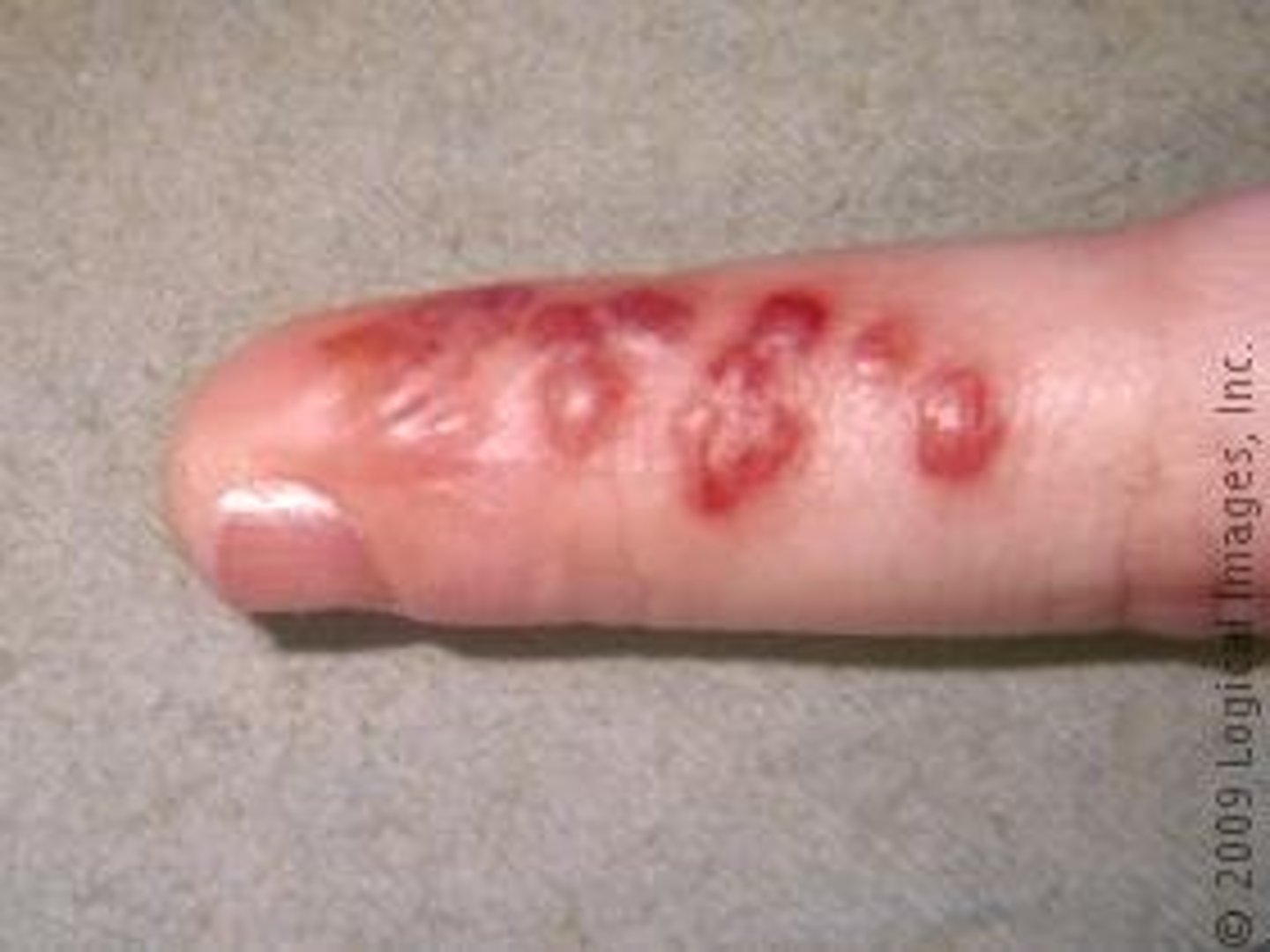 <p>vesicles and blisters on the fingers by HSV-1</p><p>Treated with acyclovir</p>