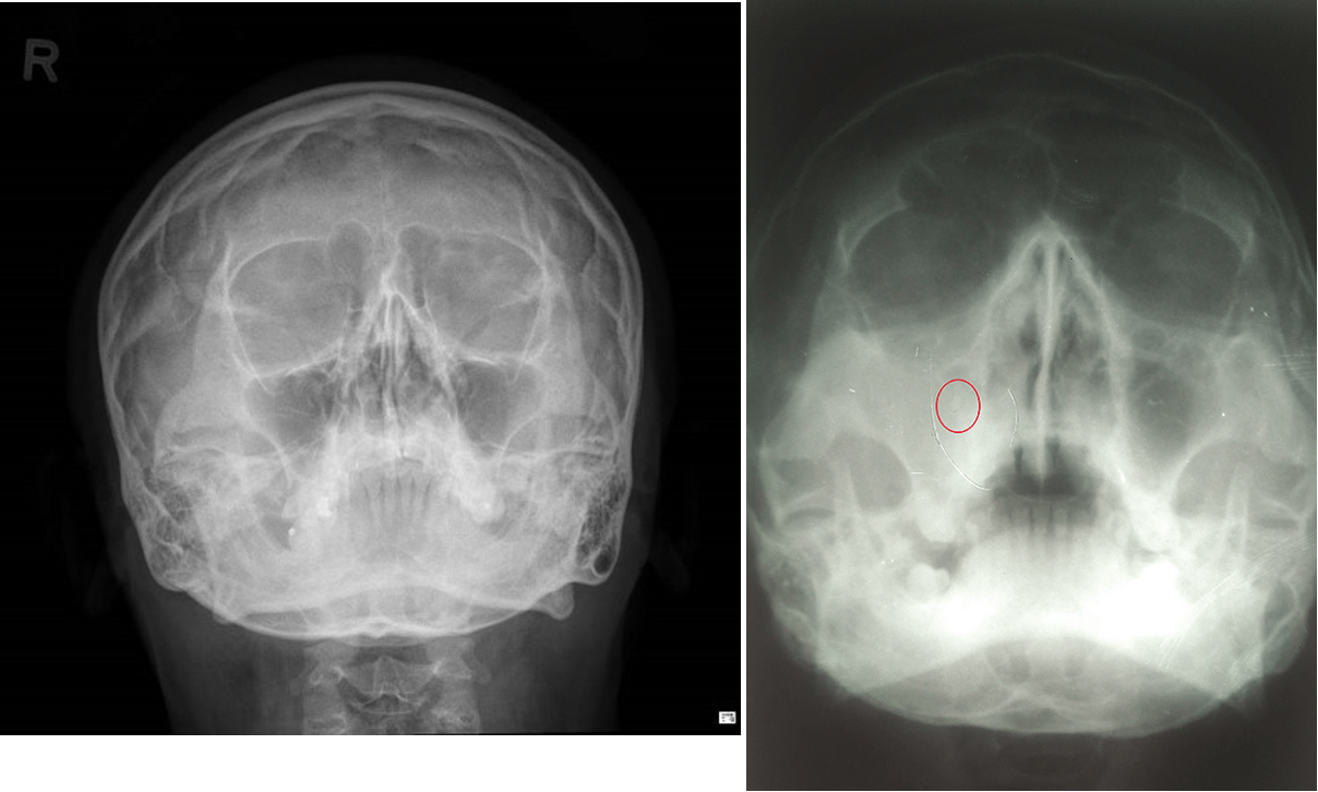 <p>pressure over maxillary/frontal sinus, watery discharge, NO fever, sx improve within 7-10 days</p>